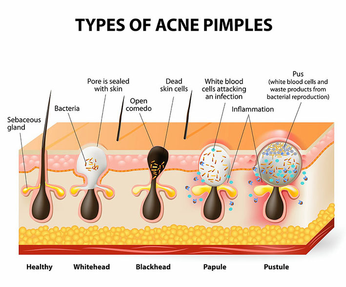types of acne